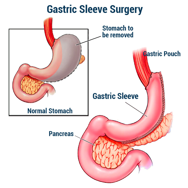 Gastric Sleeve Surgery