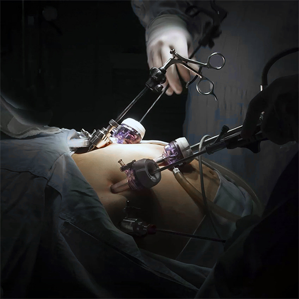 Gastric Bypass Surgery